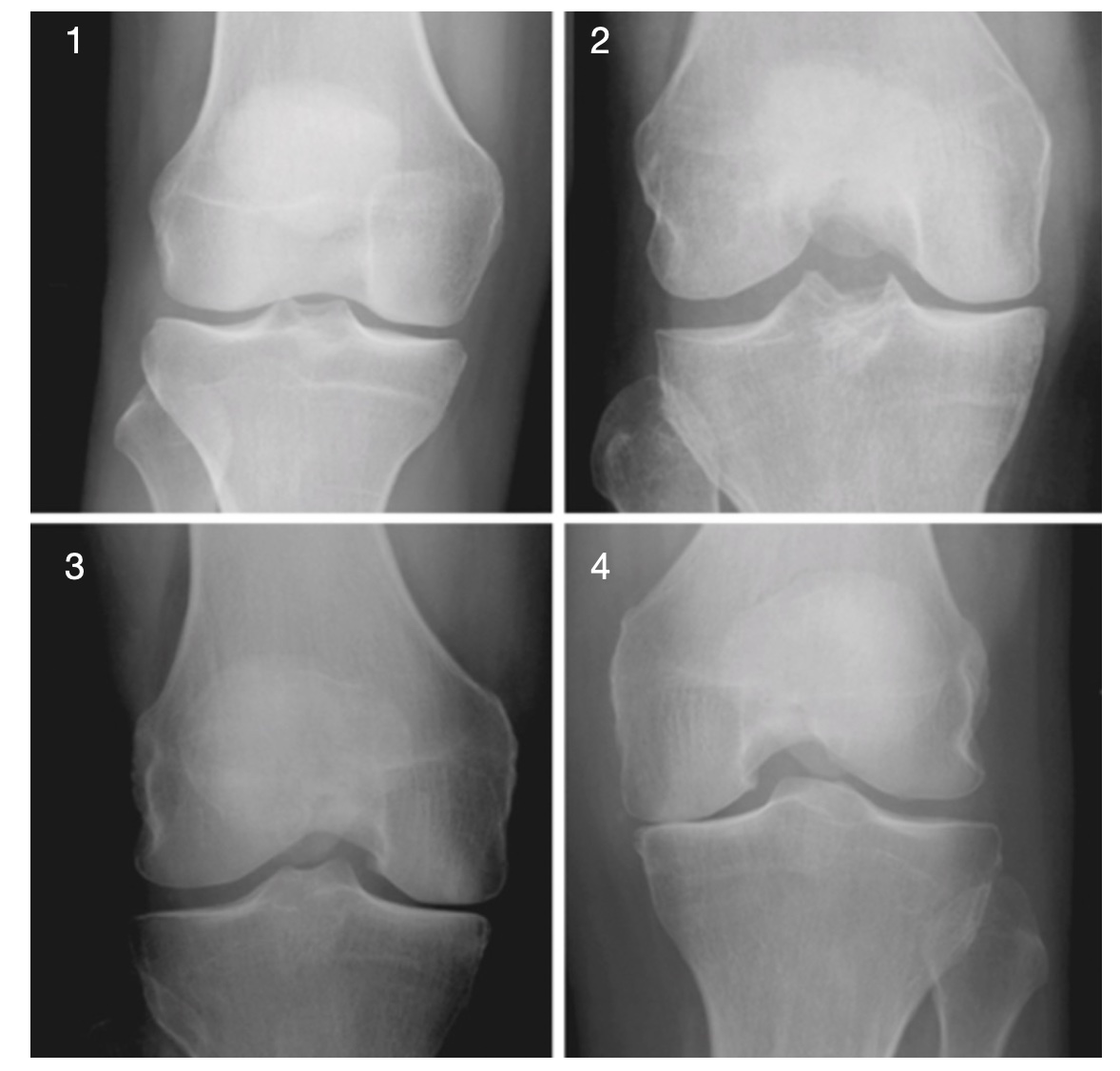 Radiographie-genou-4-stades-arthrose-dpc-medecine-generale