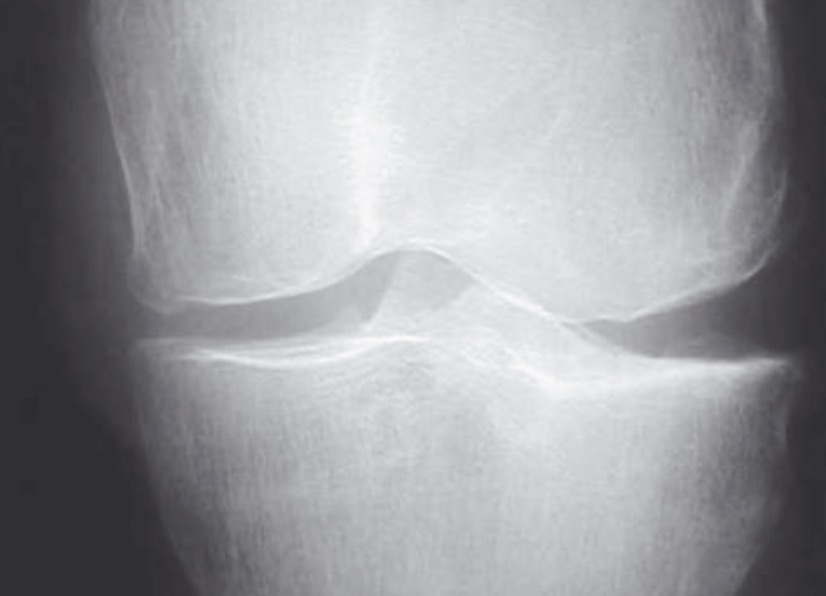 Radiographie-genou-face-dpc-gonarthrose 