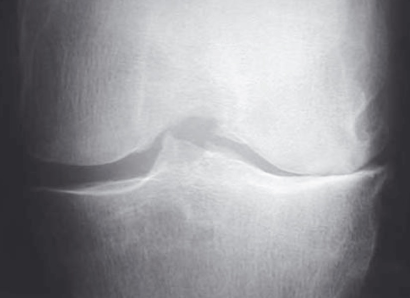Radiographie-genou-schuss-gonarthrose-dpc