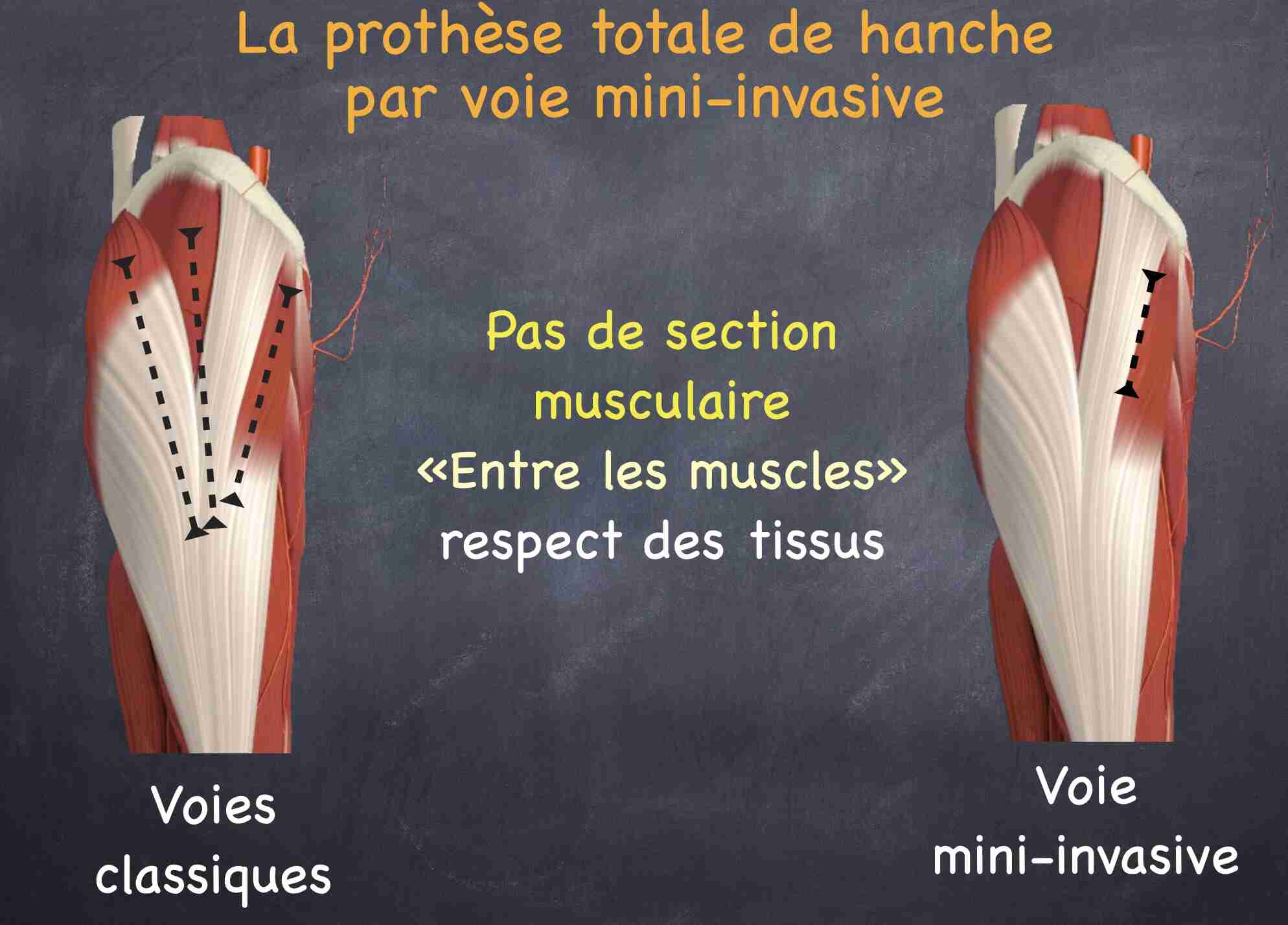 voie-mini-invasive-prothese-totale-hanche