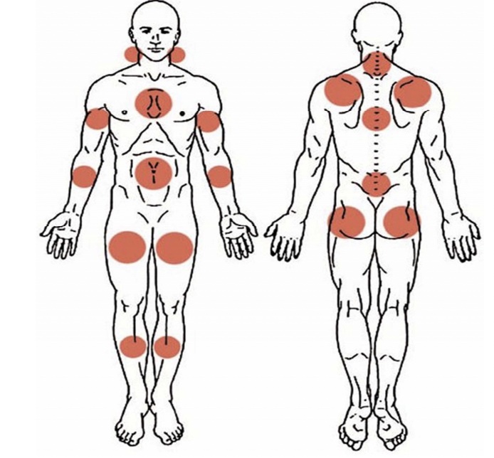 schema-zones-douleureuses-dpc-fibromyalgie