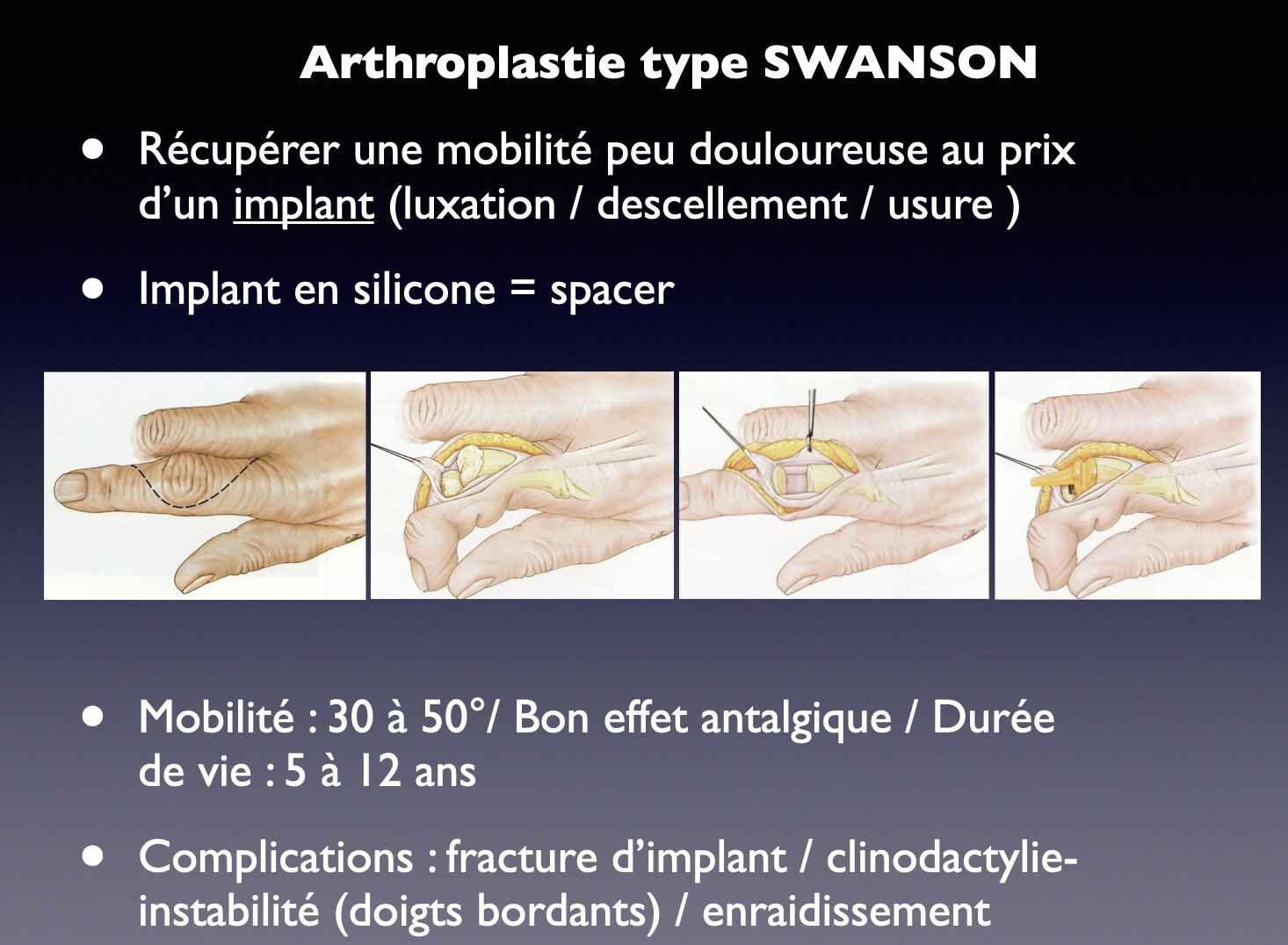 arthroplastie-ipp-mg-dpc
