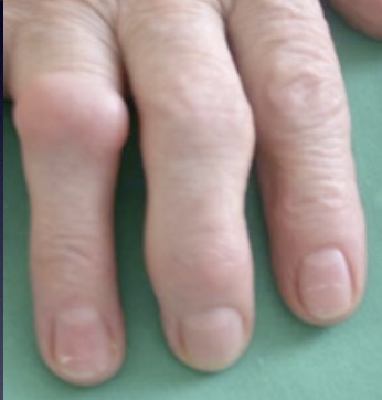 arthrose-ipp-dpc-mg