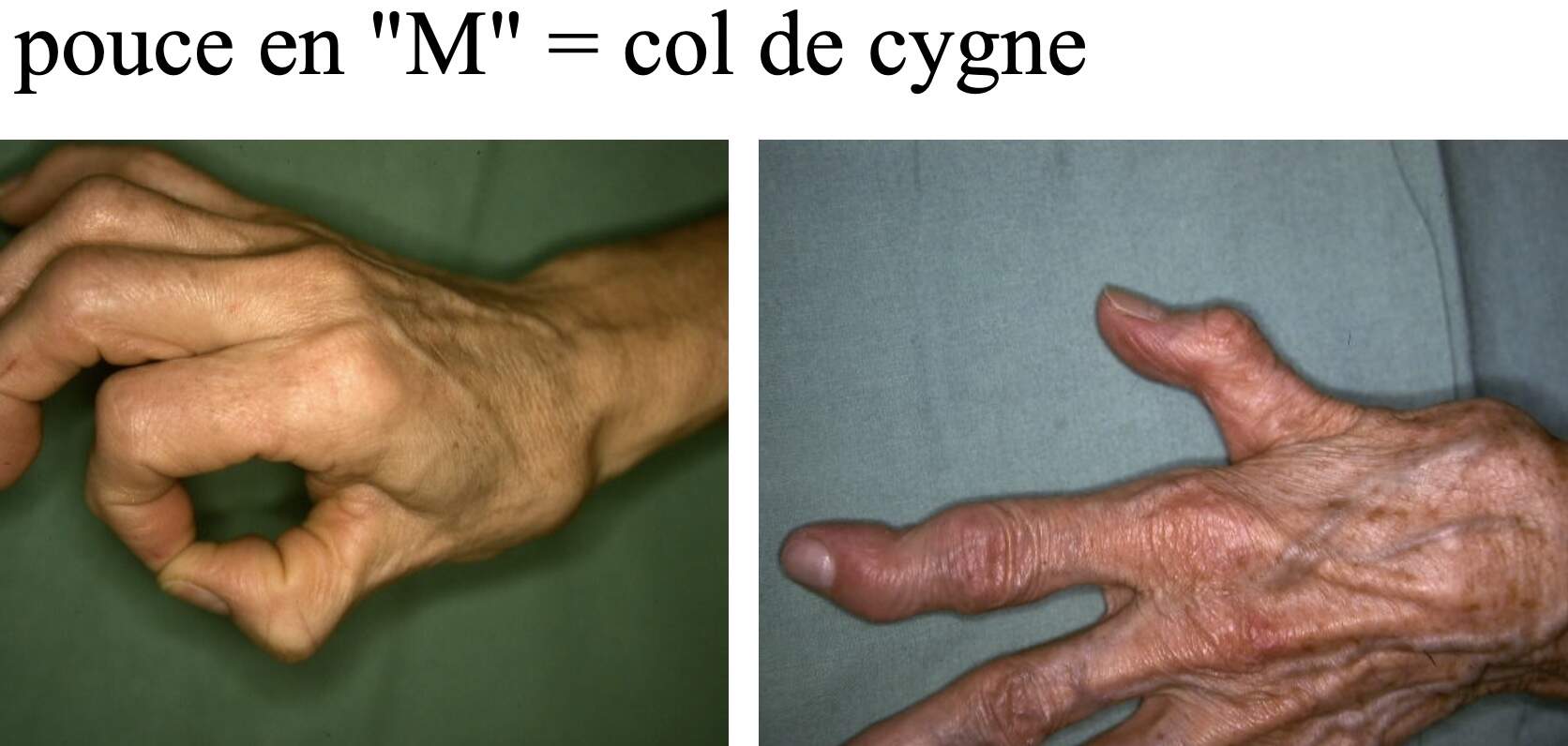 deformation-pouce-dpc-mg