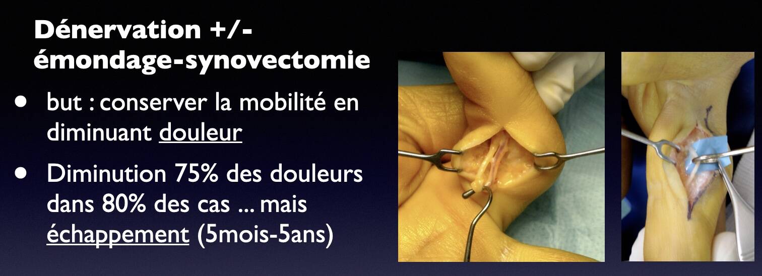 emondage-denervation