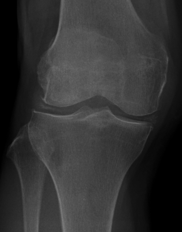 chondrocalcinose-calcification-rx-genou