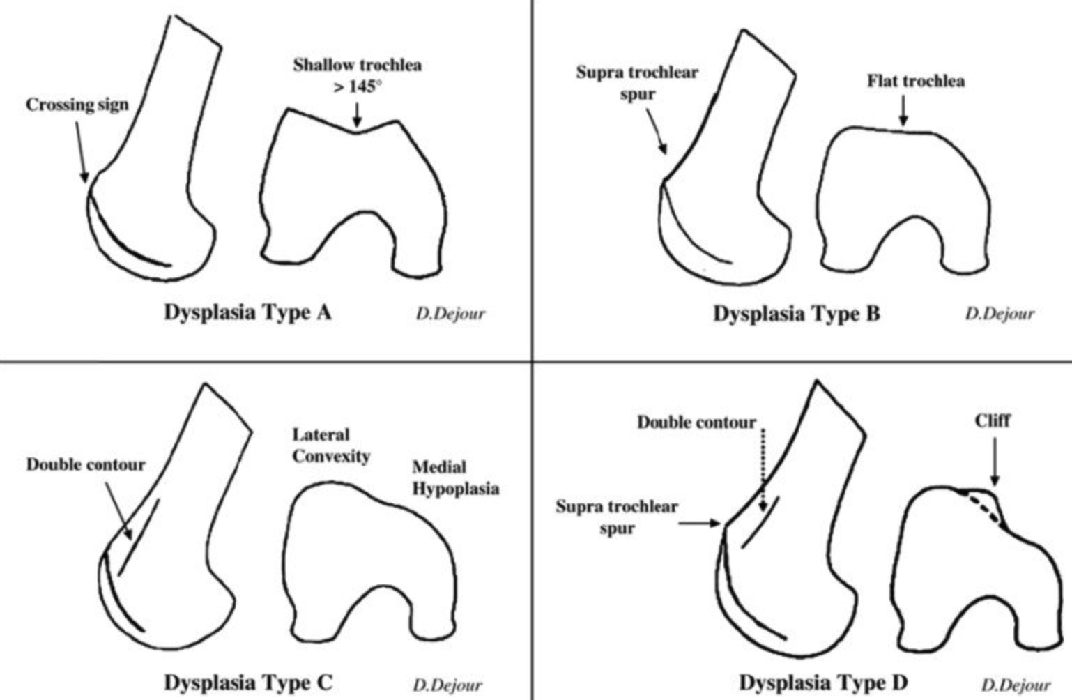 dysplasie-trochlee-dejour