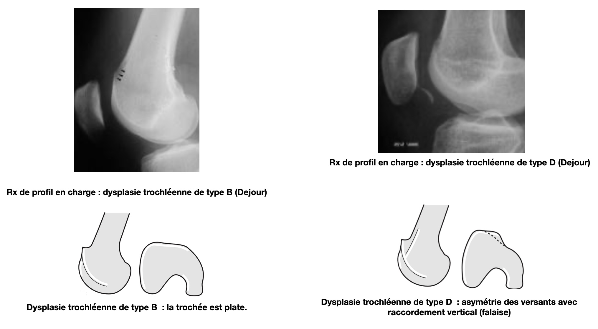 dysplasie-trochleenne-ex