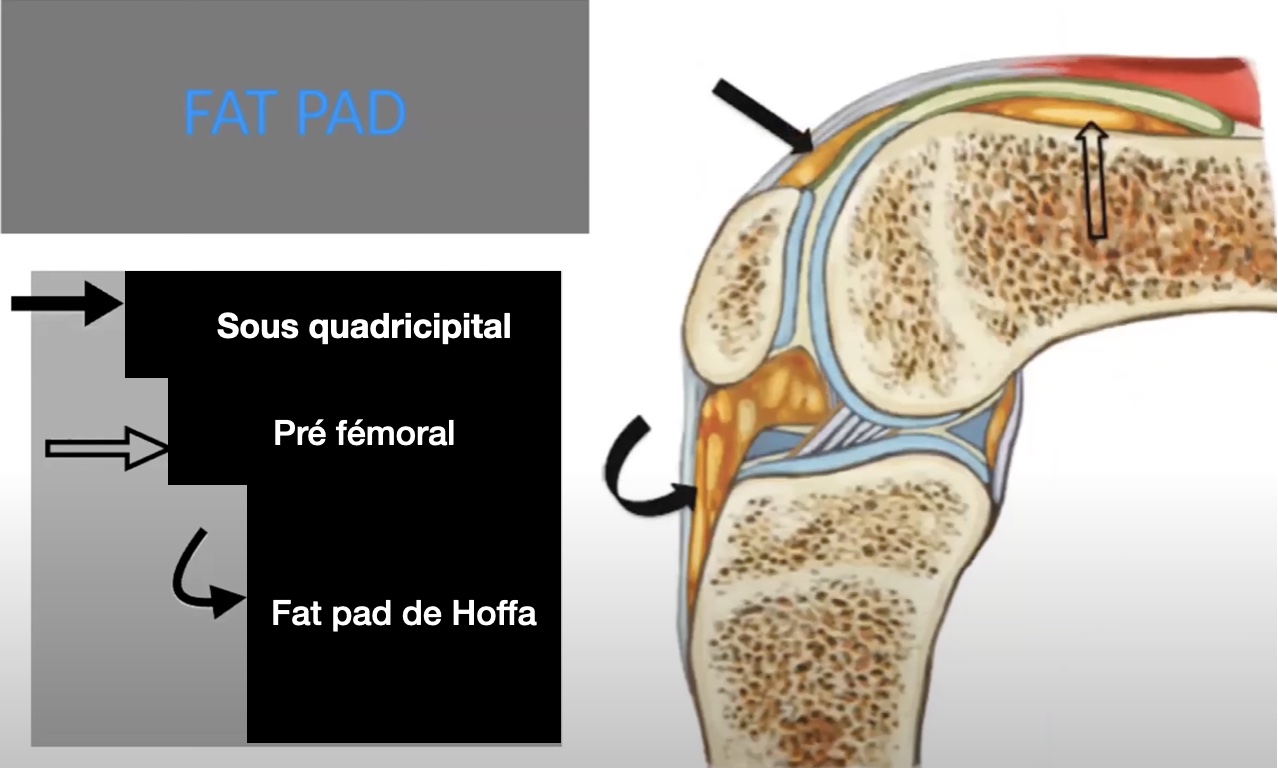 fat-pad-echographie-genou