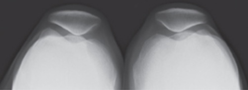 incidence-femoro-patellaire