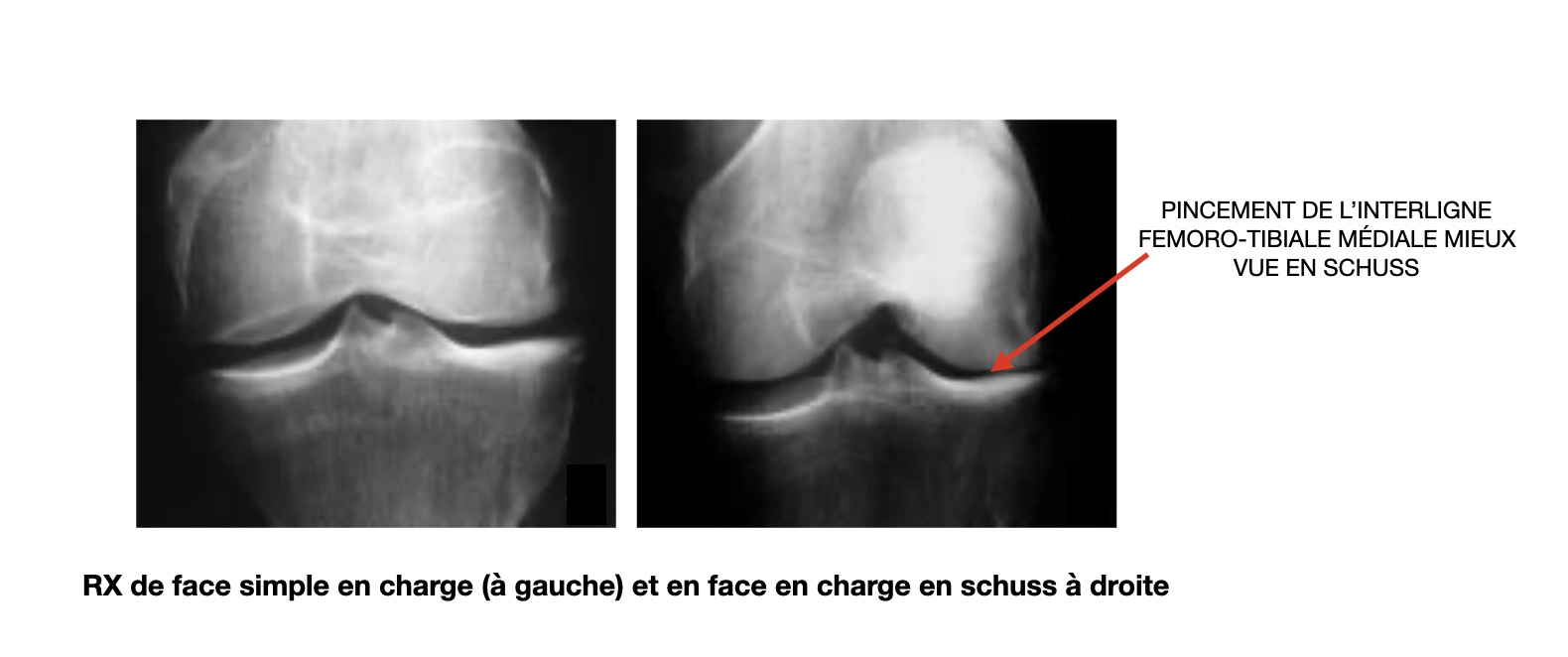 Rx-face-schuss-genou2