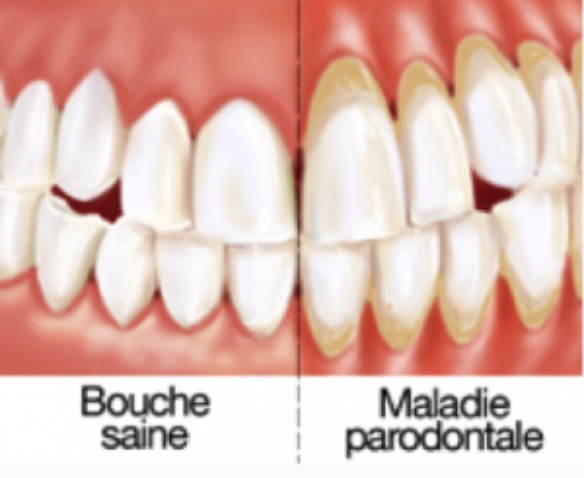 bouche-saine-versus-parodontite