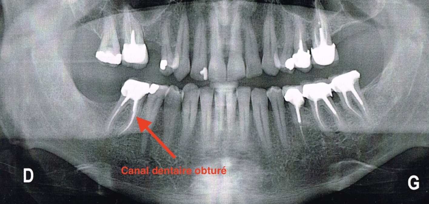 canal-dentaire-obture