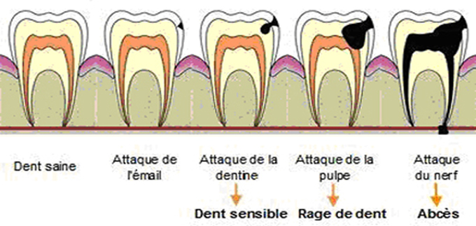 stades-caries
