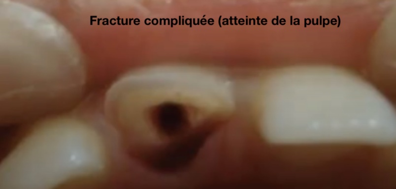 Fracture-compliquée-2