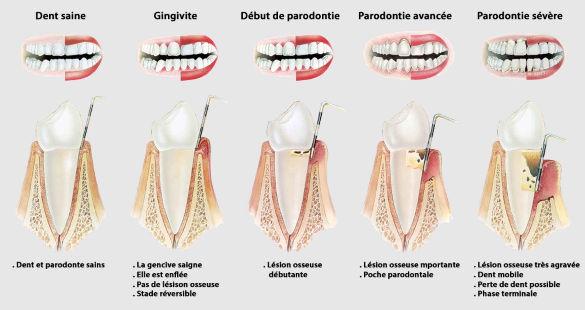 gingivite-parodontite