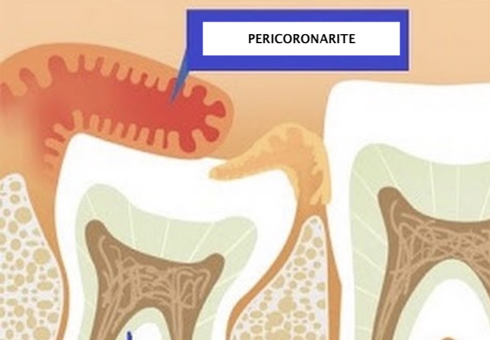 pericoronarite2