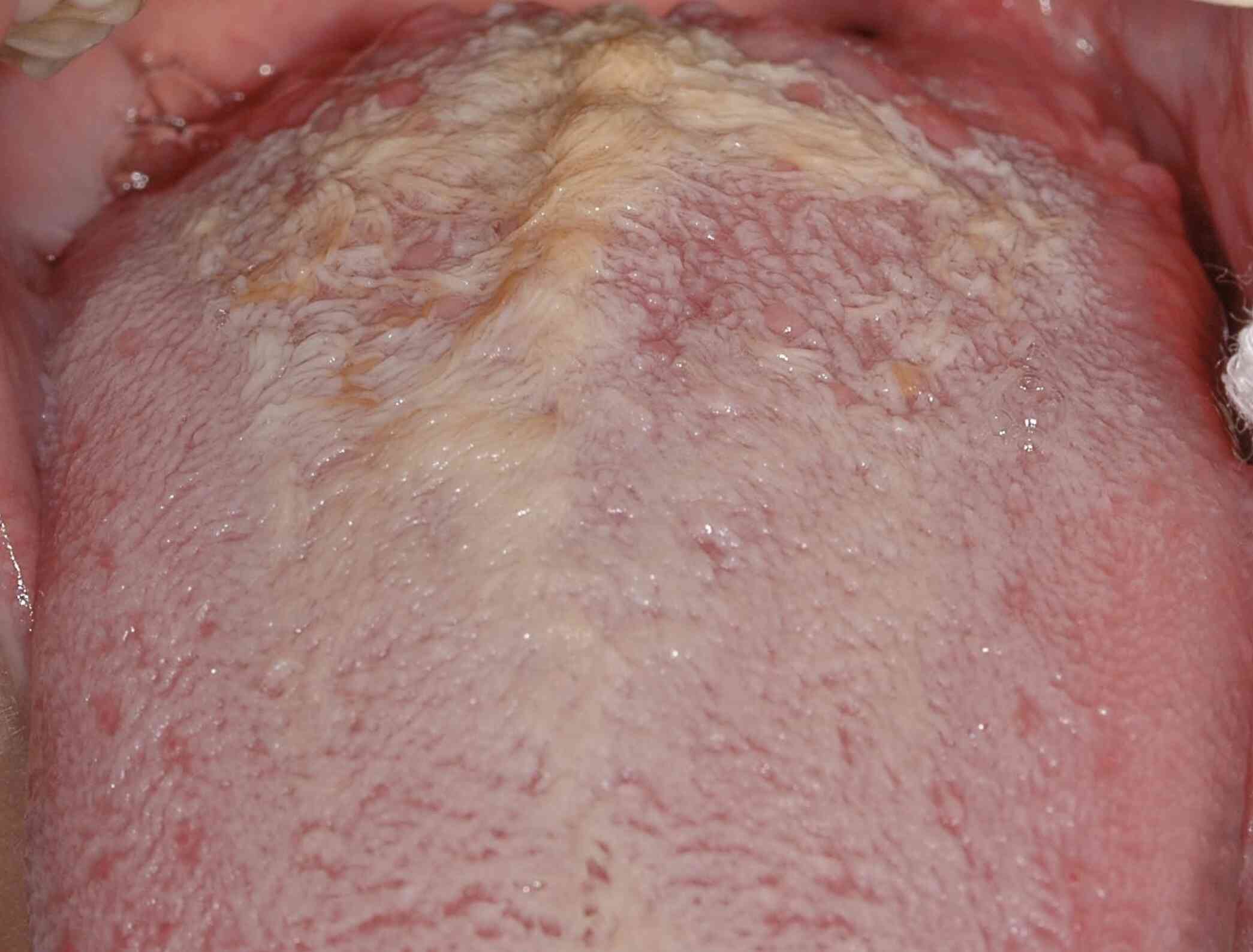 langue-chevelue-2