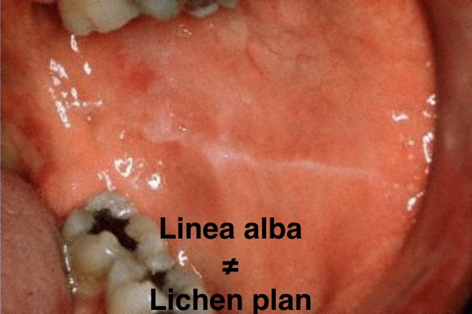 linea-alba