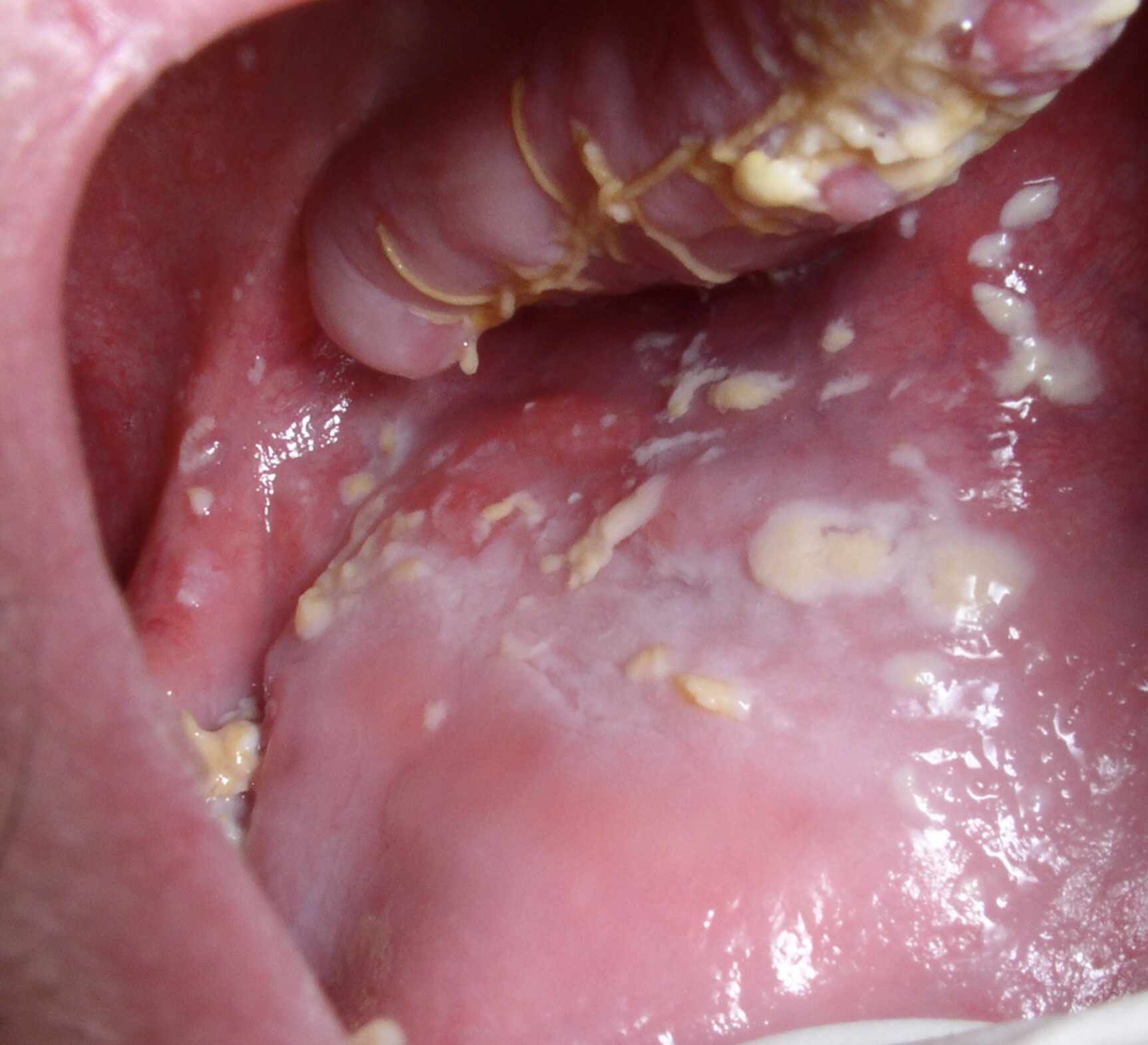 muguet-buccal