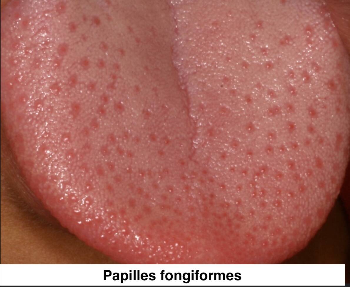 papilles-fongiformes-1