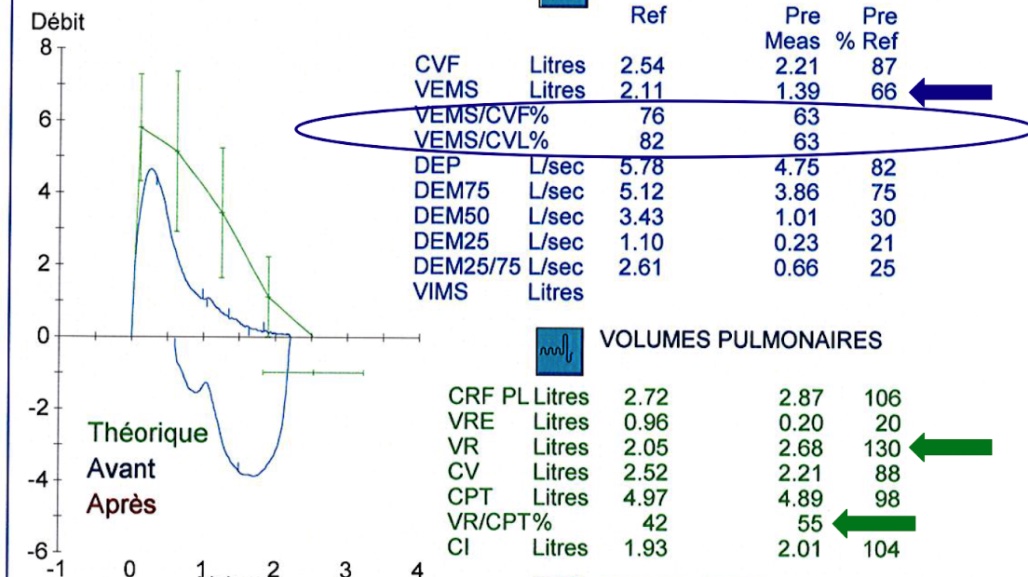 bpco-ex-dpc-mg