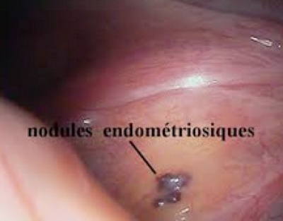 Nodules endométriosiques