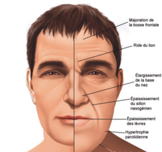 acromegalie-signes