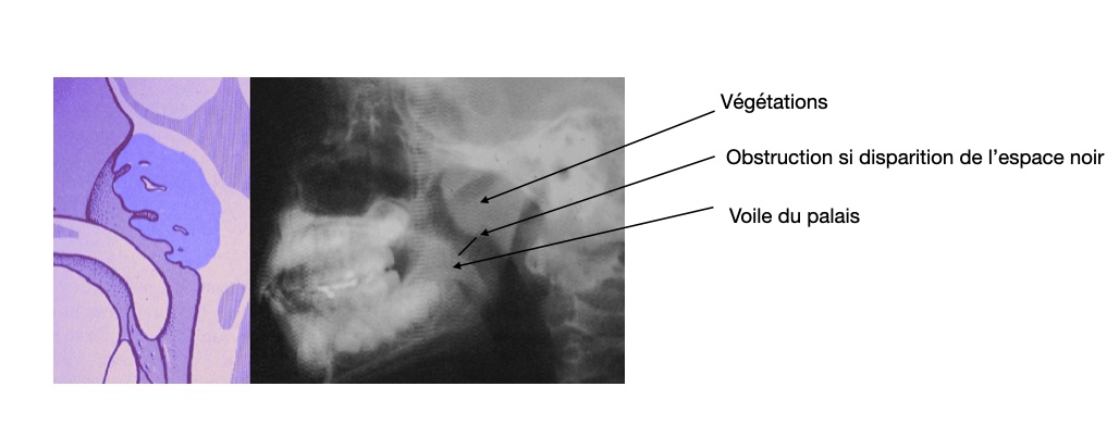 rx-cavum