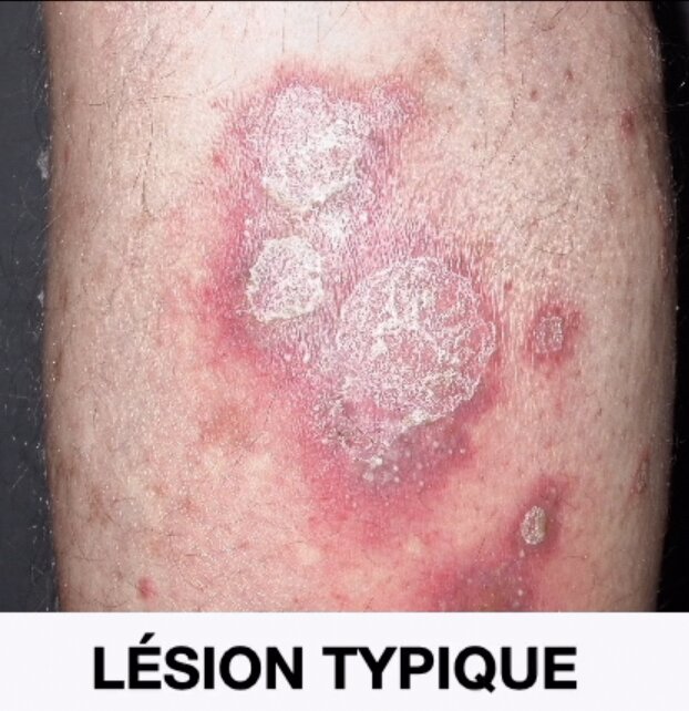 lesion-plaque-psoriasis