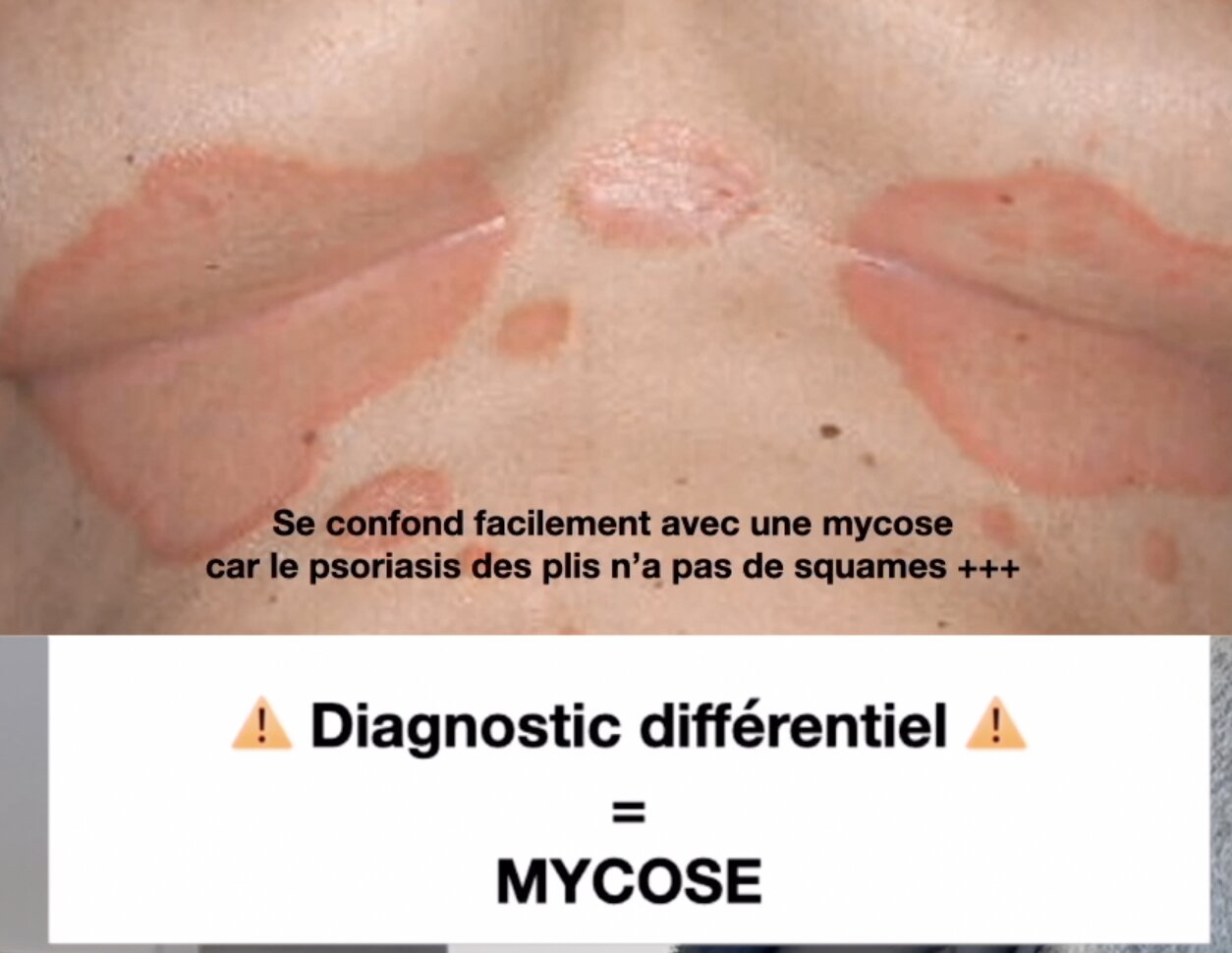 psoriasis-inverse