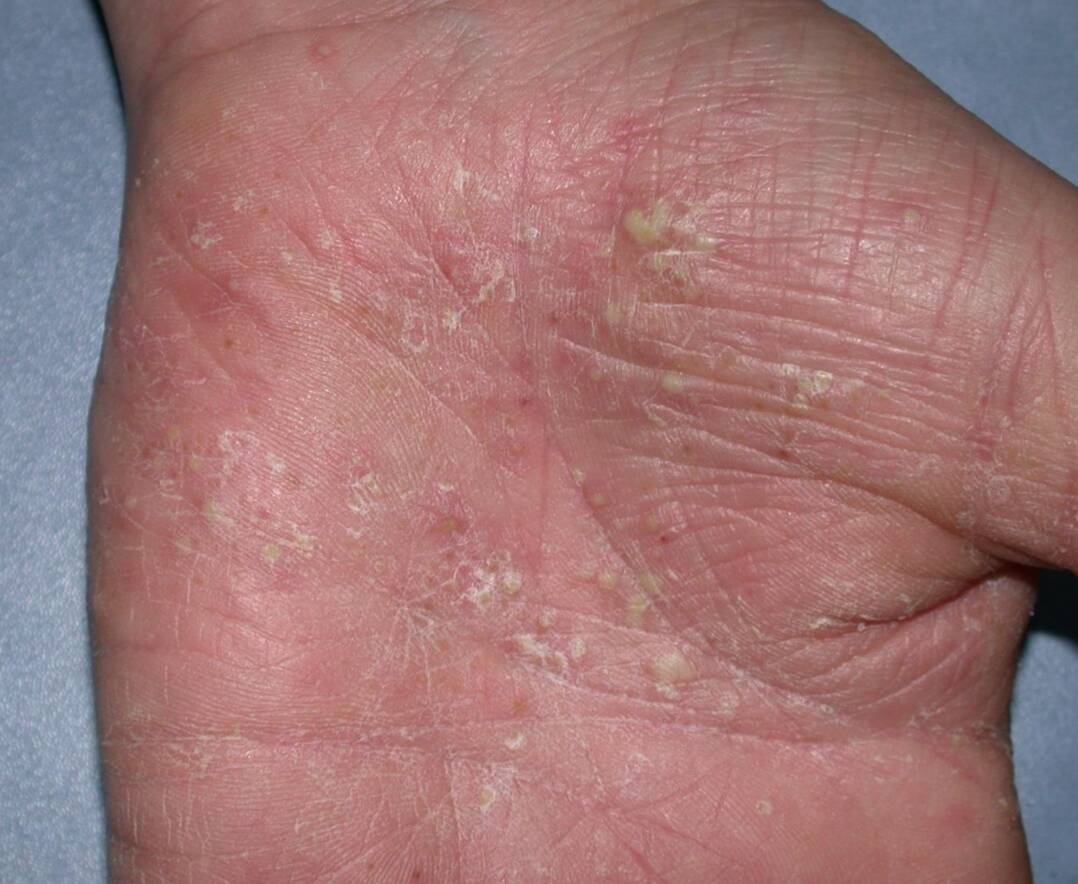psoriasis-pustuleux