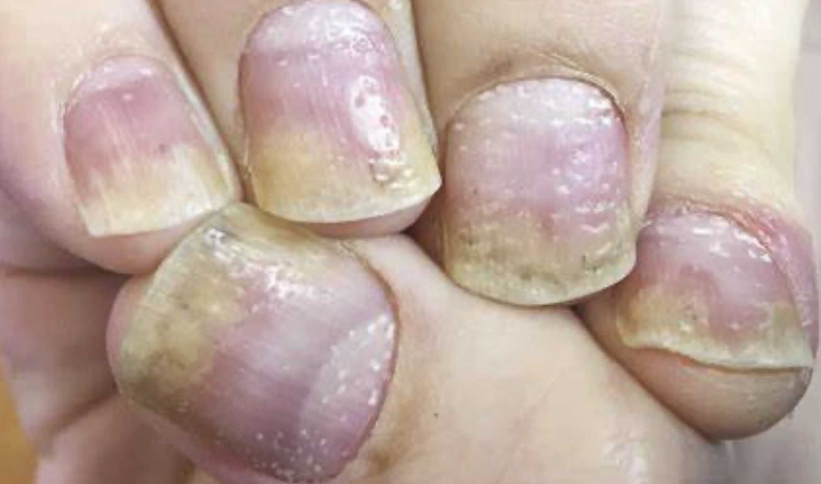 de-a-coudre-psoriasis