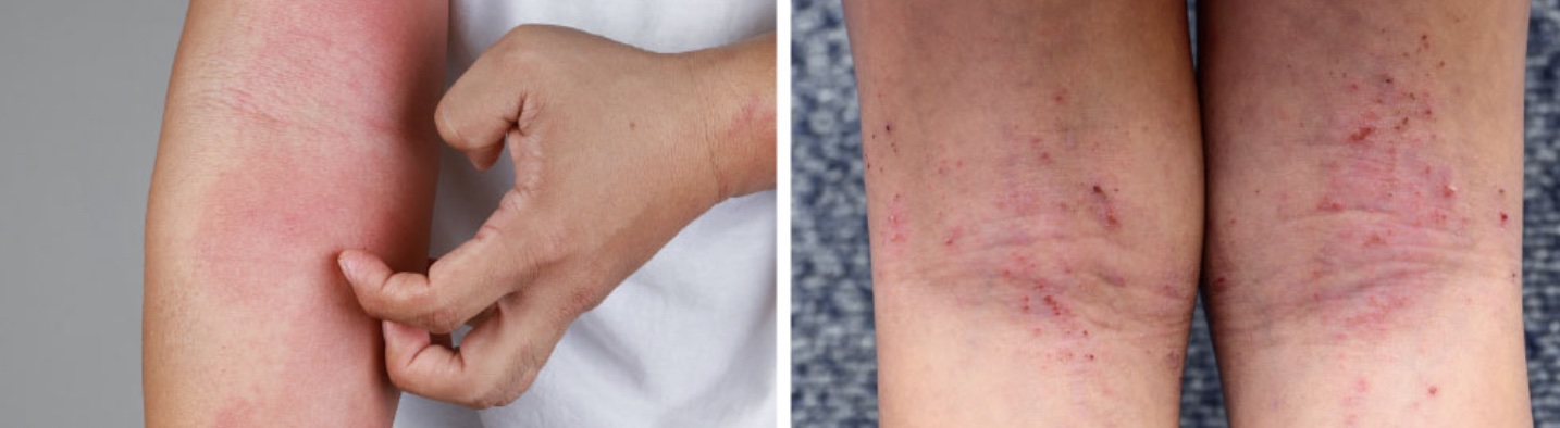 dermatite-atopique-plis