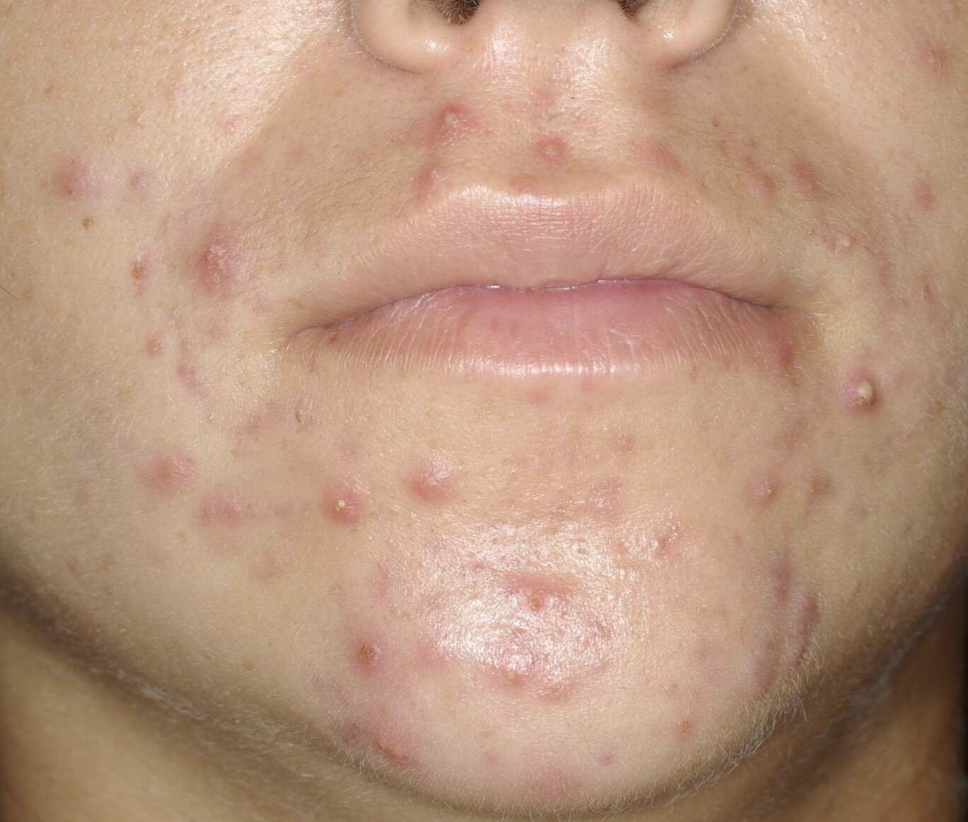 efflorescence-inflammatoire