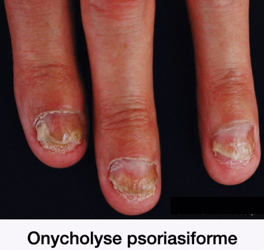 onycholyse-psoriasique