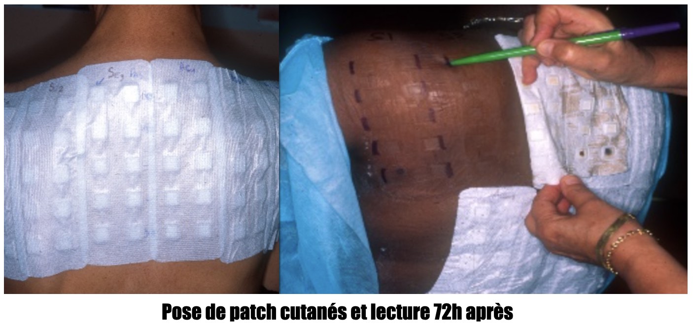pose-patch-cutanés