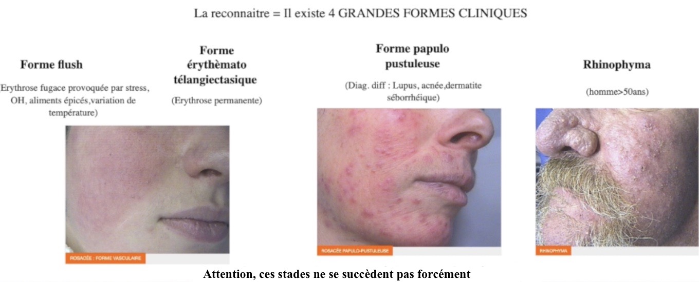 rosacee-clinique