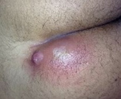 abces-anal