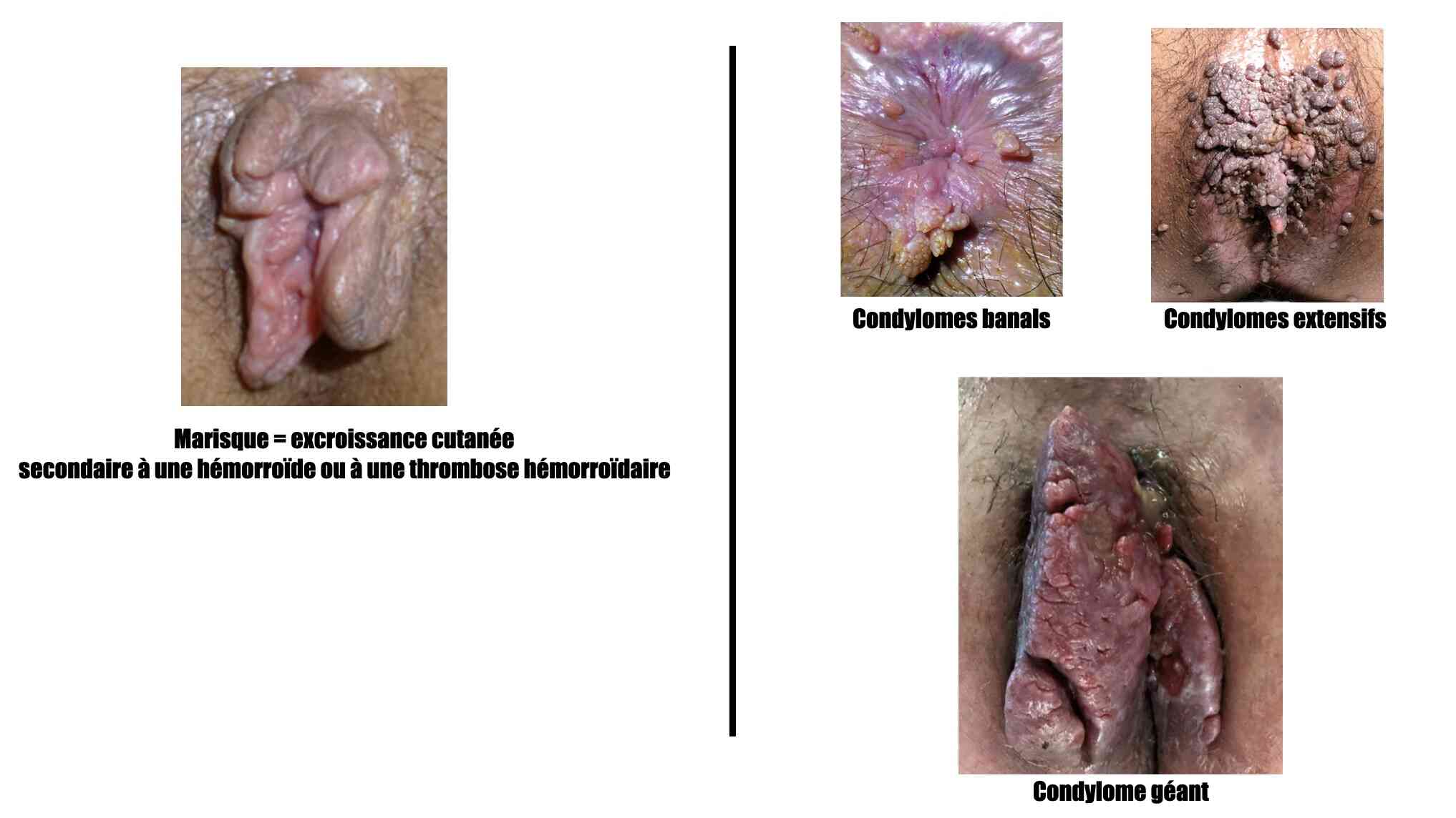 condylome-marisque