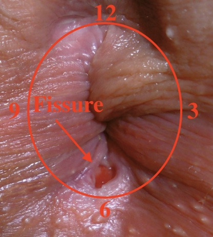fissure-