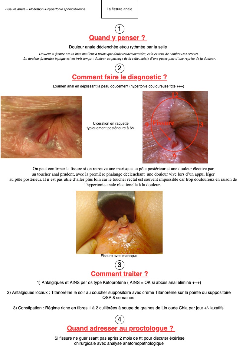 fissure-anale-fiche