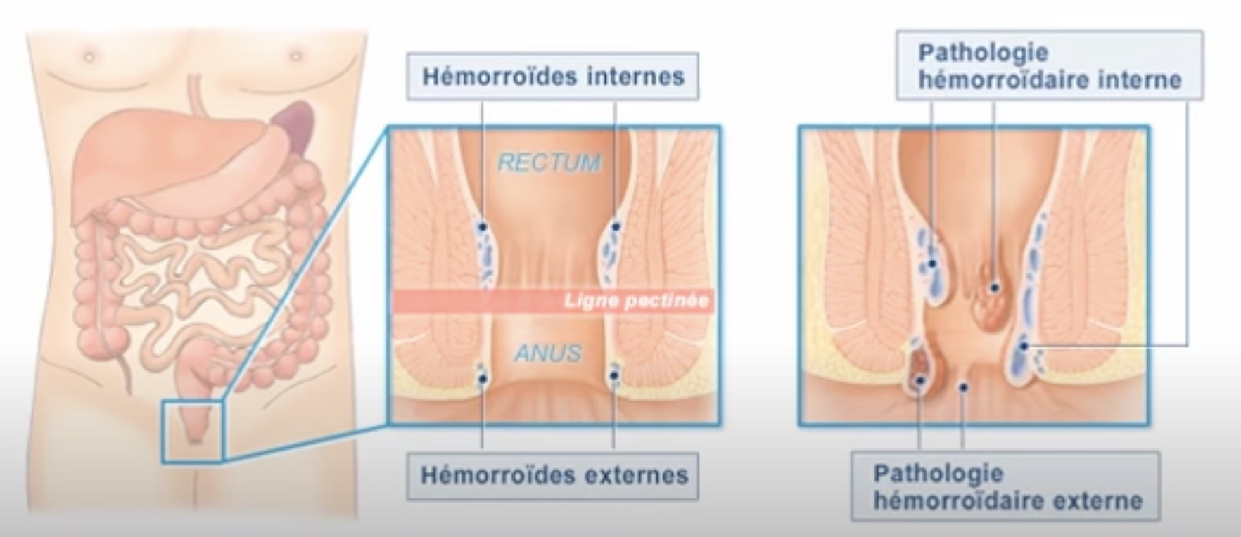 hemorroide-anatomie