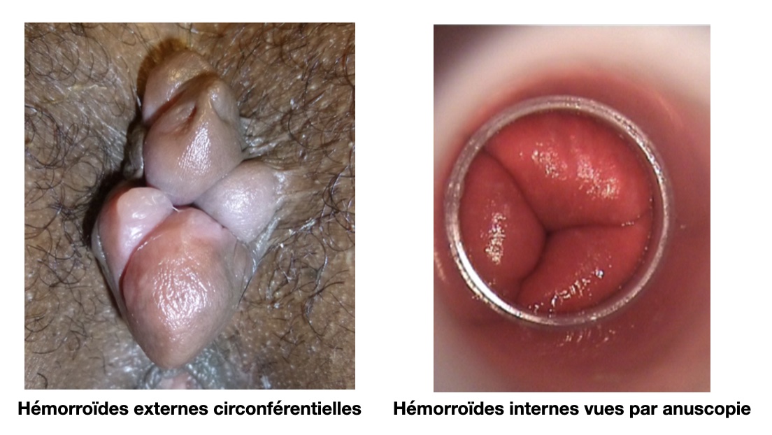 Proctologie en MG