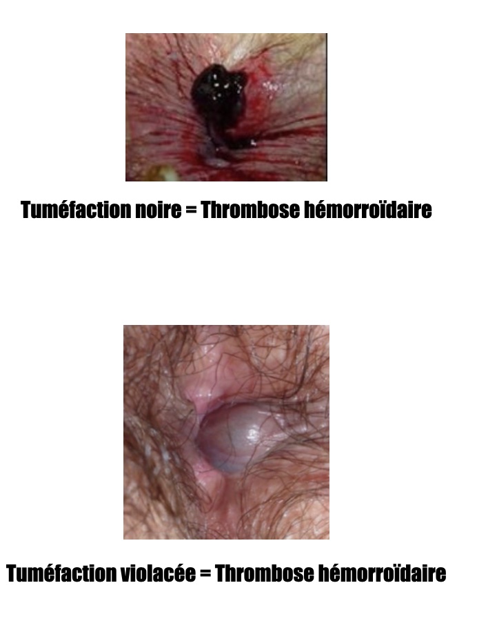 thrombose