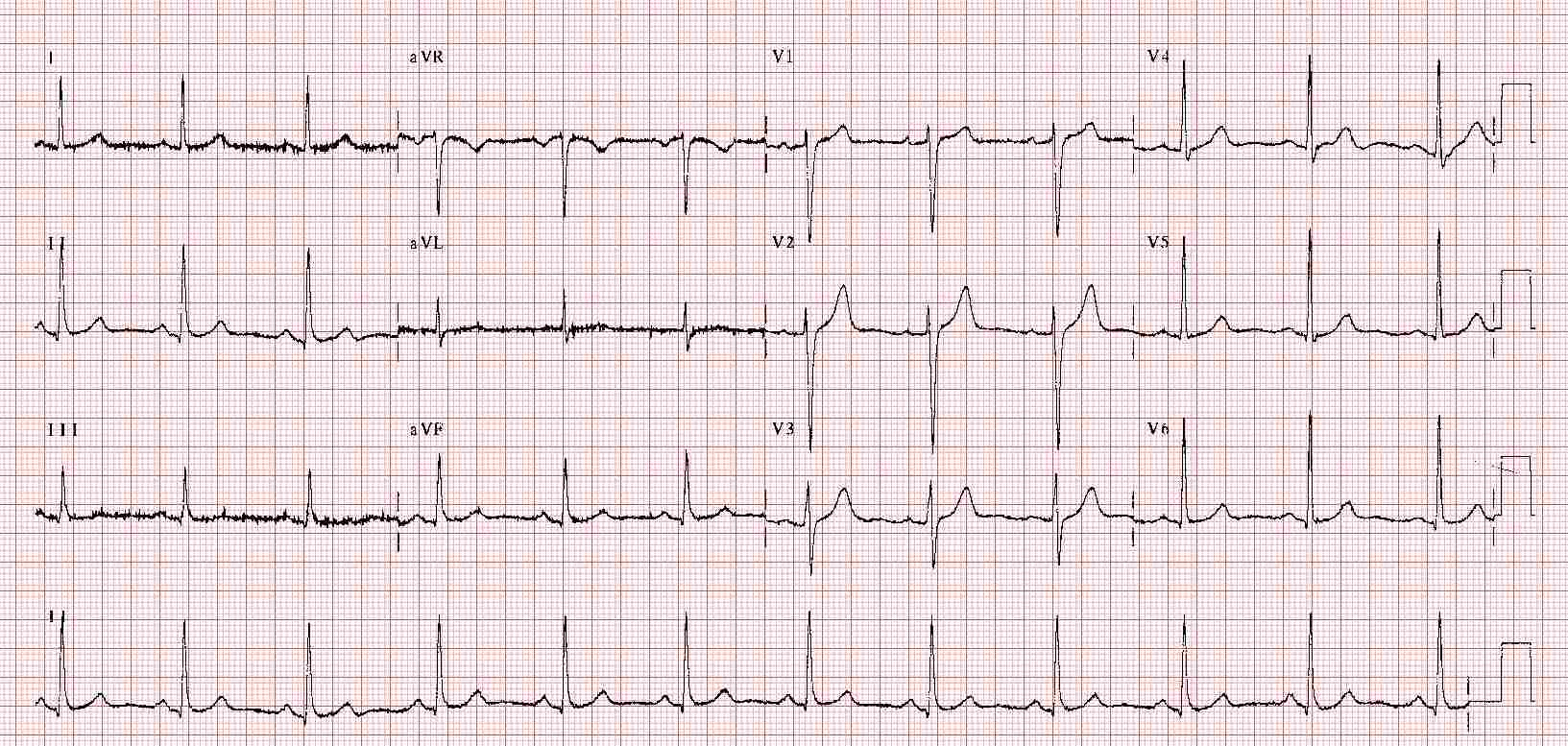 ECG