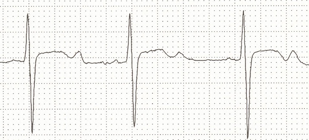 ecg-hypokaliémie