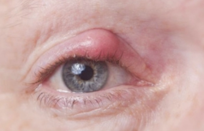 chalazion