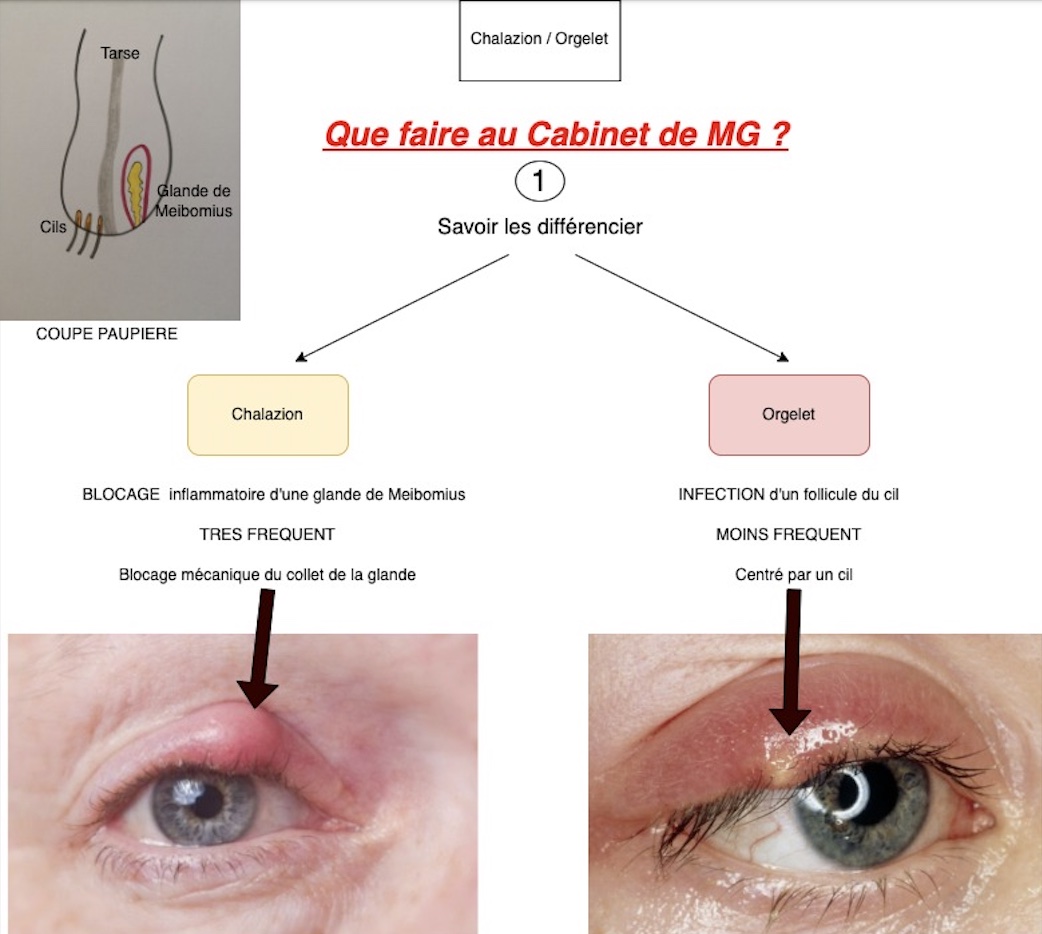 chalazion-orgelet-stye