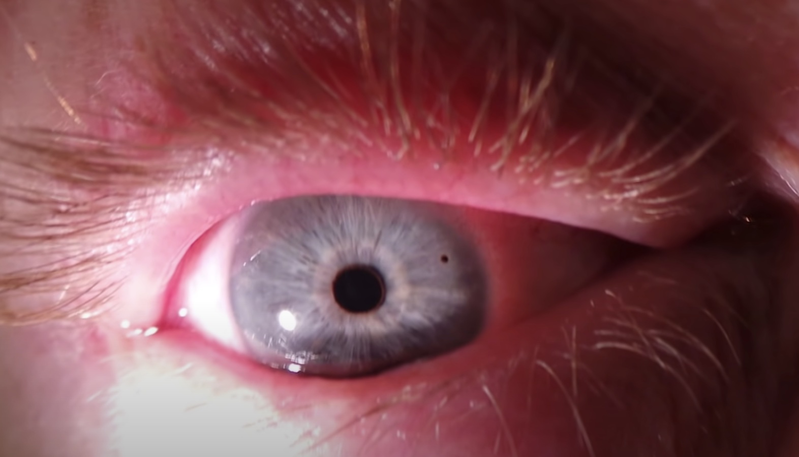 oeil-droit-rouge-corps-étranger-conjonctival